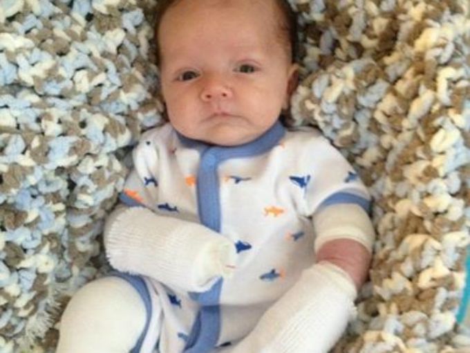 baby born with rare skin blister disease